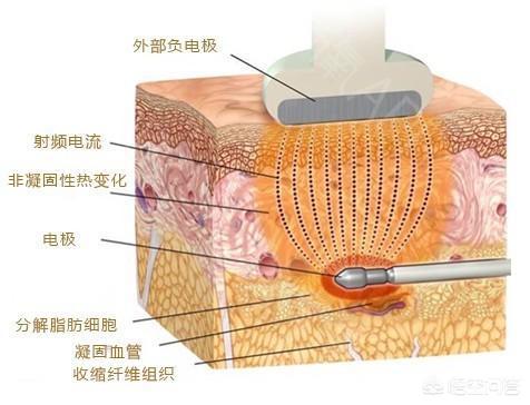 直播欧洲杯怎么瘦脸:欧洲杯直播用什么